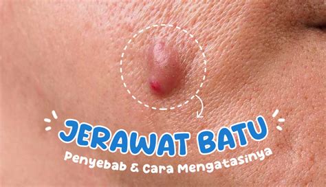 jerawat batu menular