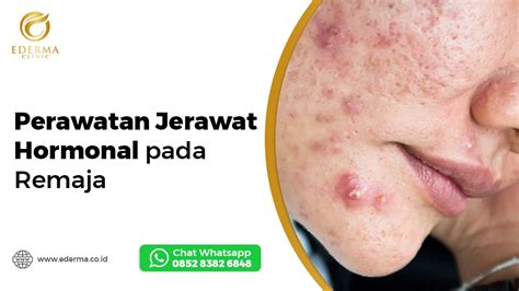 Jerawat di Dahi Remaja: Atasi Jerawat dan Dapatkan Kulit Bersih dan Sehat