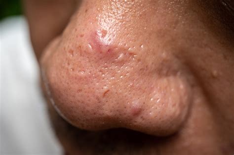 jerawat+di+atas+hidung