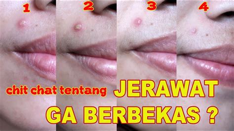 Image of a woman with acne