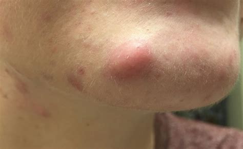 Jerawat Mendingin yang Membandel: Tips Atasi dan Cegah