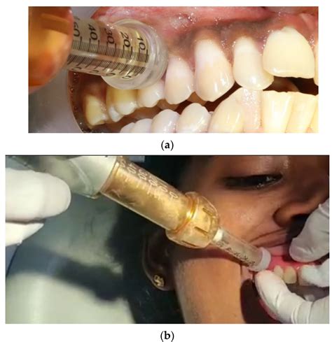 Jet Injection Administration