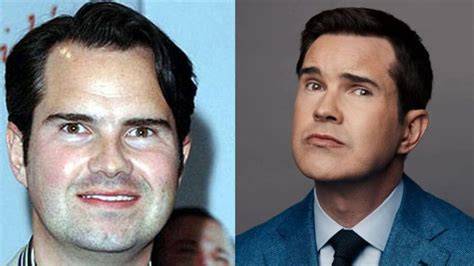 jimmy carr plastic surgery