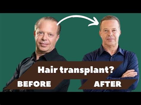 joe dispenza hair transplant