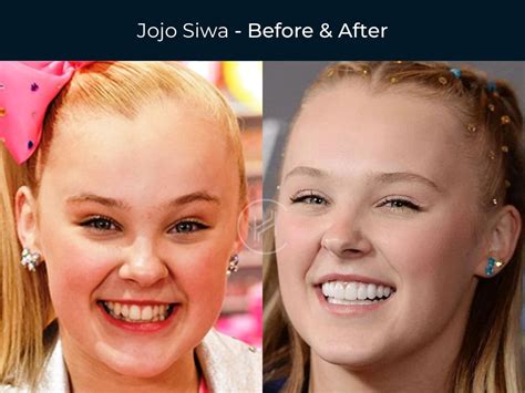 jojo siwa veneers