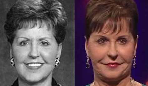 Unveiling The Truth: Joyce Meyer's Journey With Cosmetic Surgery