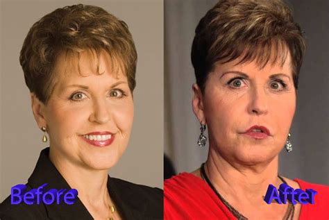 joyce meyer before plastic surgery