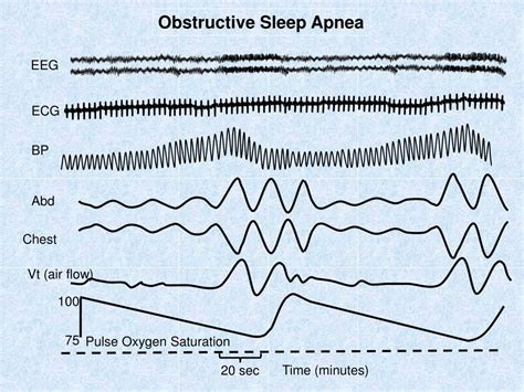 jurnal tentang sleep apnea eeg