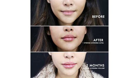 Juvederm Lip Filler Side Effects