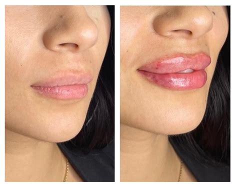 Juvederm On Lips