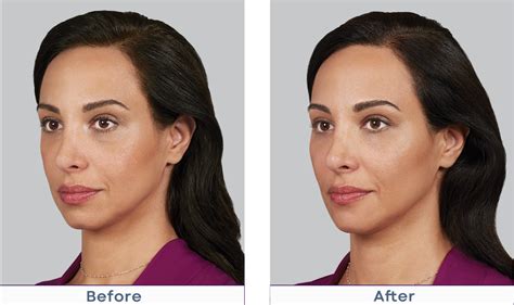 juvederm voluma near me