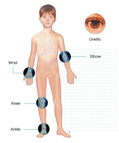 juvenile idiopathic arthritis