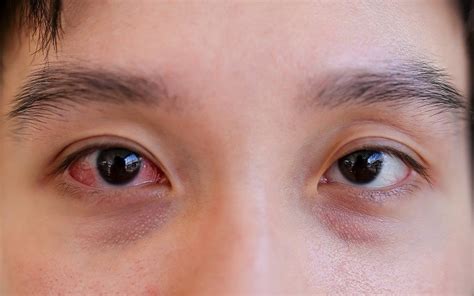 kantung mata alergi