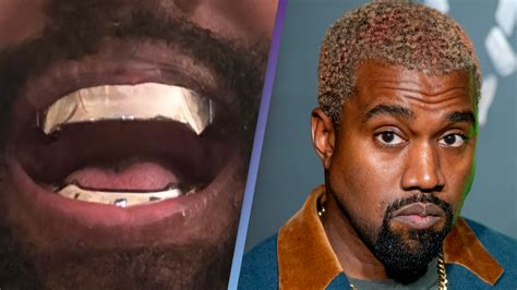 Kanye Teeth: Trendy Dental Solutions?