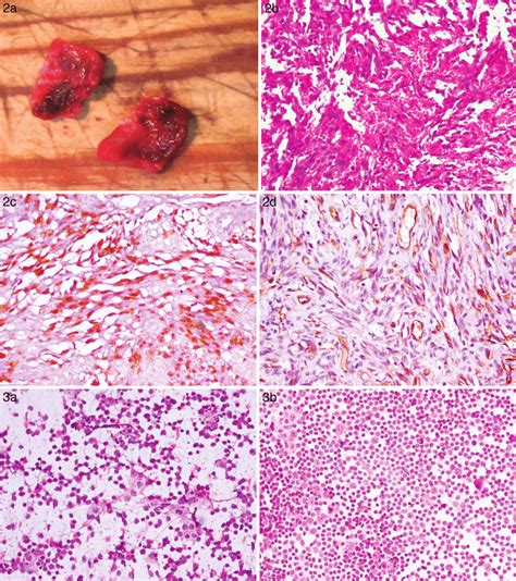 kaposi sarcoma lymph node