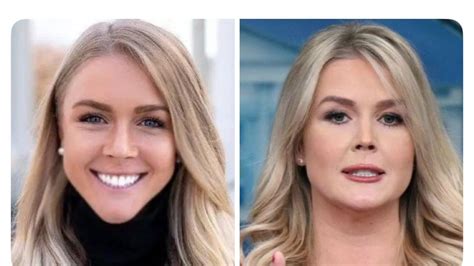 karoline leavitt plastic surgery