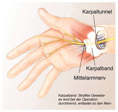 karpalsyndrom symptome