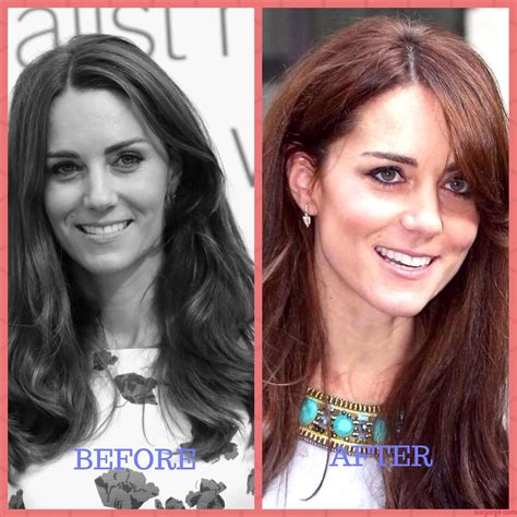 kate middleton what surgery