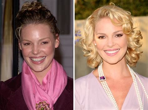 katherine heigl teeth before and after