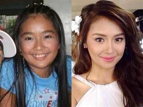 kathryn bernardo plastic surgery