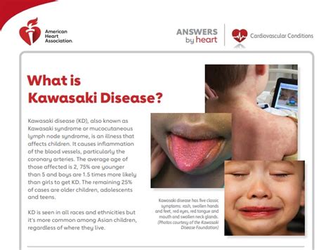 kawasaki disease and stroke