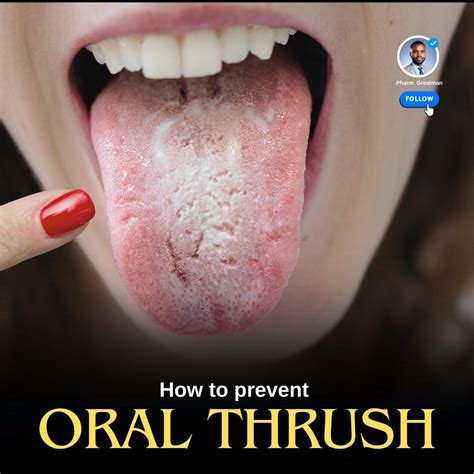 keep getting thrush male