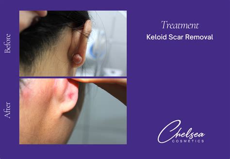 Effective Keloid Scar Removal: Say Goodbye to Raised Scars