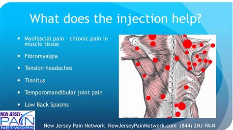 kenalog trigger point injections