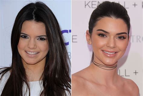 kendall before after