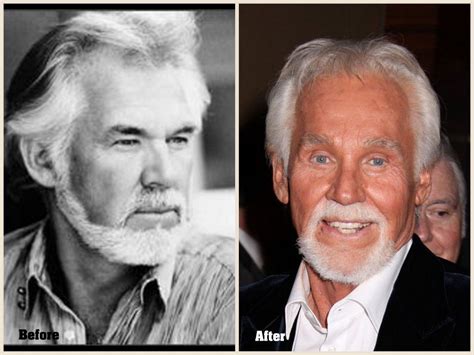 kenny rogers eye lift