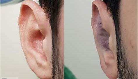 Kepçe Kulak Ameliyatı Sonrası Enfeksiyon