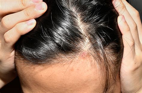 Gejala Kepala Pusing dan Rambut Rontok: Tanda Penyakit Apa?