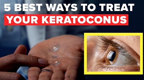 keratoconus treatment without surgery