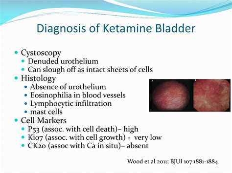 ketamine and bladder problems