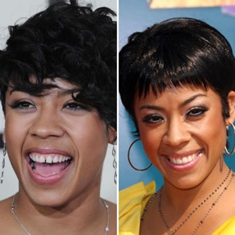keyshia cole teeth before and after