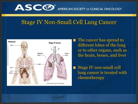 keytruda lung cancer stage 4