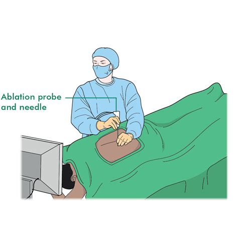 Kidney Ablation Meaning