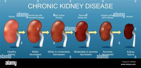 Kidney Filtration Failure