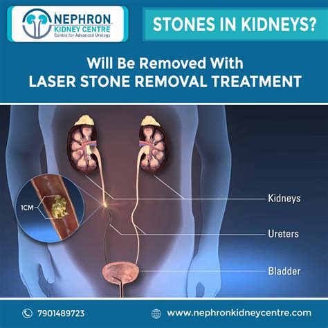 What to Expect from Kidney Stone Removal Surgery: A Step-by-Step Guide to a Pain-Free Life