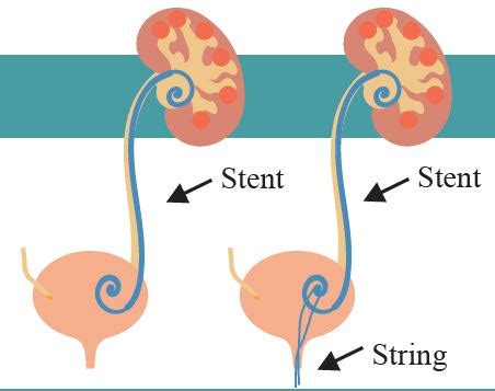 Understanding the Role of a Kidney Stone Stent: What You Need to Know
