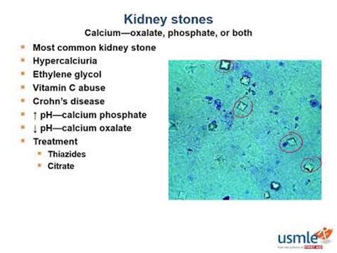 Kidney Stone Usmle