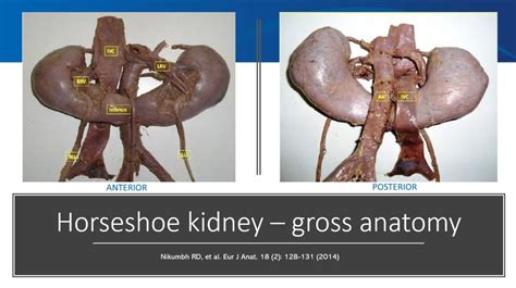 kidney stones horseshoe kidney