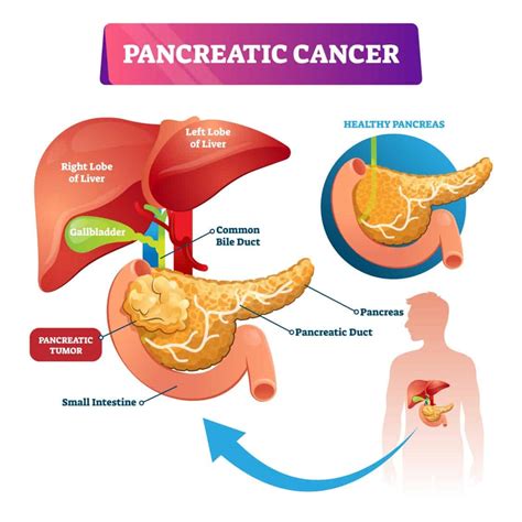 king charles cancer pancreatic