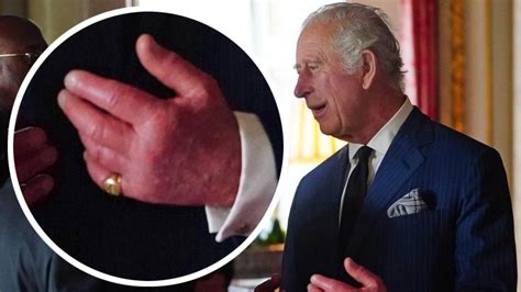 king charles iii fingers condition