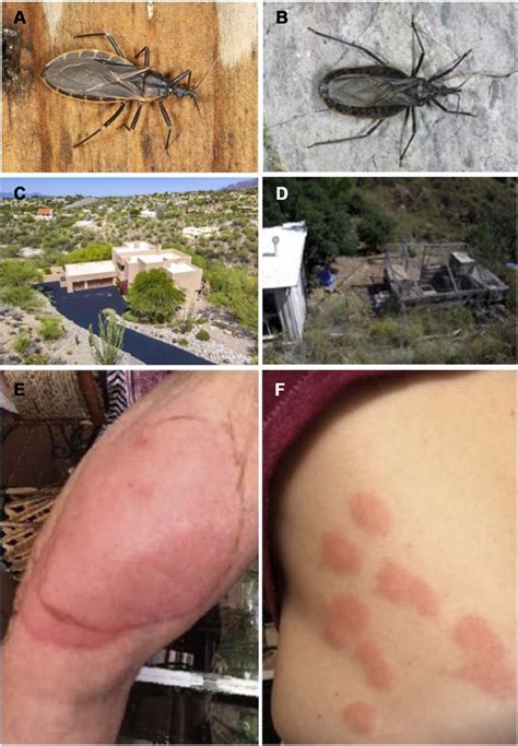 What You Need to Know About Kissing Bug Bite Symptoms and Risks