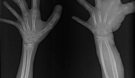 Klippel Trenaunay Weber Syndrome Radiology Trénaunay Case