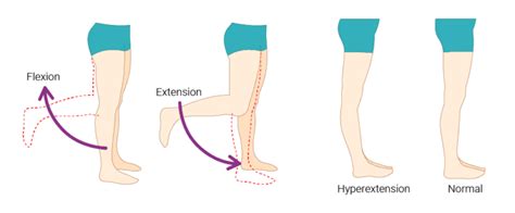 knee hyperflexion vs hyperextension