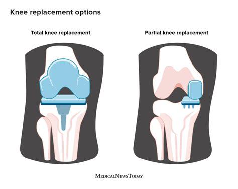 Knee Replacement Surgery Options