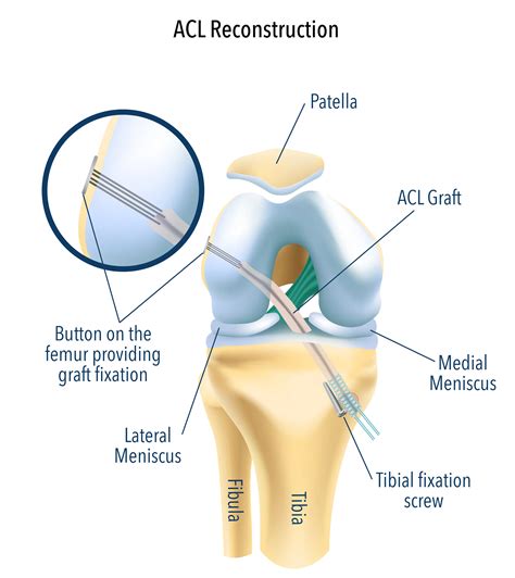 Knee Snapping After Acl Surgery