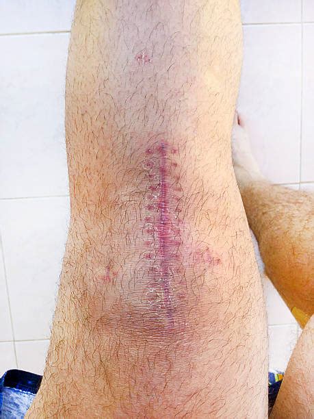 knee surgery scars